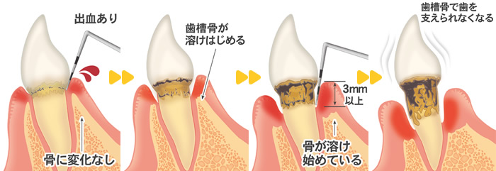 歯周病予防のための歯石除去